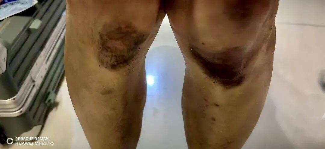 生死25分钟！这双膝盖，太心疼了……